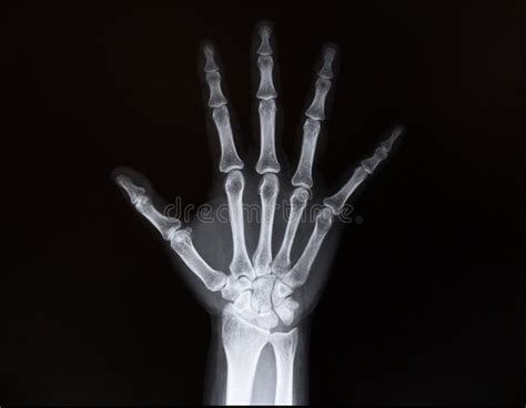 X Ray Of Wrist Of The Arms Stock Image Image Of Care 65571469