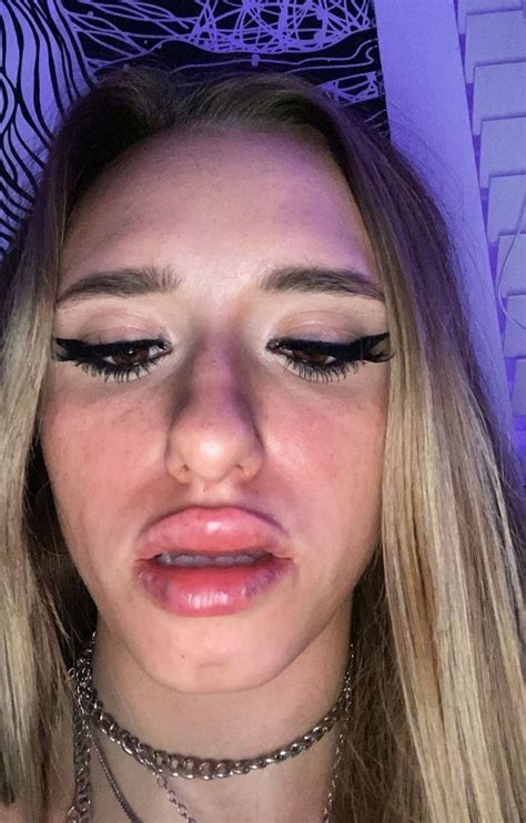 woman left ‘looking like a character from monsters inc after her lips ballooned because of
