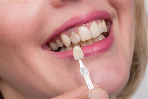 What To Expect With Dental Veneers Smile Solutions