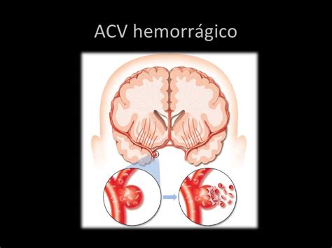 Enfermedad cerebrovascular hemorrágica qué es y su fisiopatología