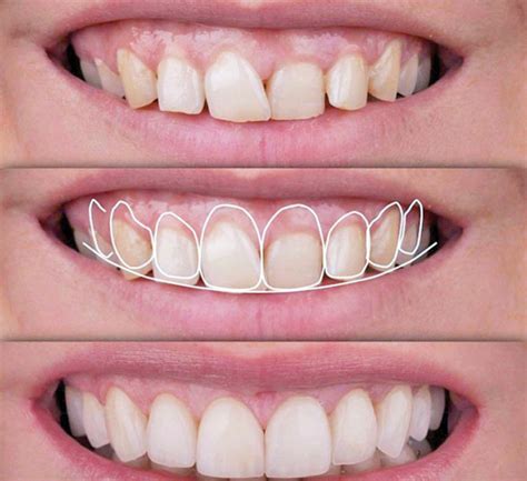 Gingivoplastía Y Gingivectomía Clínica Dental Smile Clínica Dental Smile