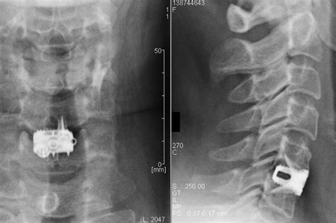 Anterior Cervical Discectomy Fusion In Nj Comprehensive Spine Care