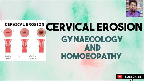Cervical Erosion Gynaecology And Homoeopathy 1 Requested Video