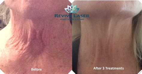 Laser hair removal neck before and after. Neck tightening - before and after - Revive Laser and Skin ...