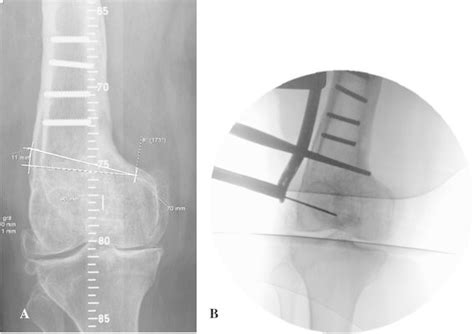The Starting Point For The Distal Osteotomy At The Lateral Femur Is