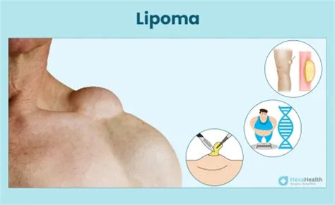 Lipoma Meaning Causes Symptoms Pictures Types