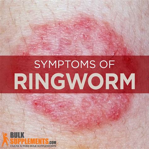 Ringworm Rash