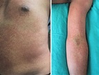 Morbilliform rash was the commonest presentation of rash | Download ...
