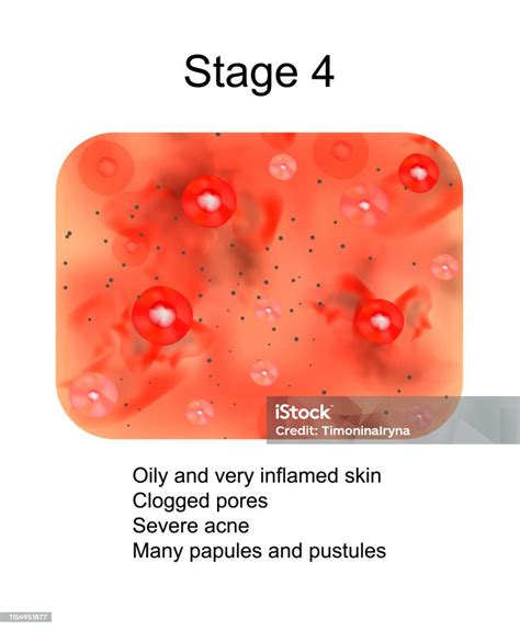 Stage 4 Of Development Of Acne Inflamed Skin With Scars Acne And