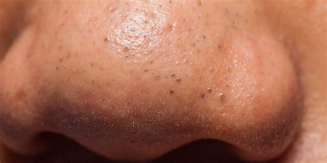 14 Tips To Get Rid Of Blackheads On Your Nose Chin And Forehead