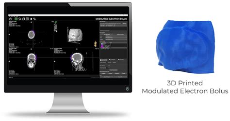 Adaptive 3d Printing Bolus Software Radiation Therapy Nl Tec