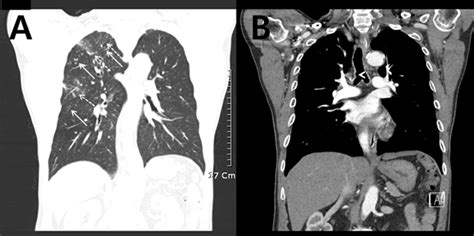 Chest Computed Tomography Shows Clustered Centrilobular Nodules Arrows