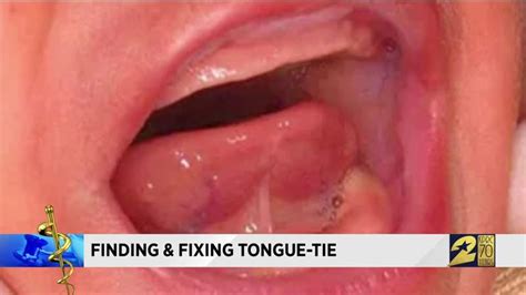 Mother Says Tongue Tie Procedure Helped Her Baby Babe