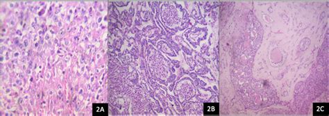 Cureus Unclassified Mixed Germ Cell Sex Cord Stromal Tumor Of The Ovary An Unusual Case Report