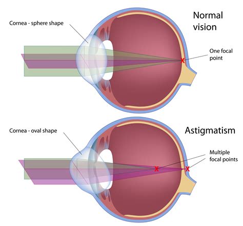 What Is Astigmatism Causes Symptoms Treatment