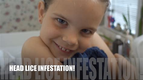 Head Lice Infestation Youtube