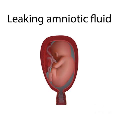 Leaking Amniotic Fluid Photograph By Veronika Zakharovascience Photo
