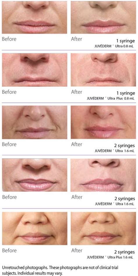 Juvederm Ultra Plus Before And After Lipstick Lipstutorial Org