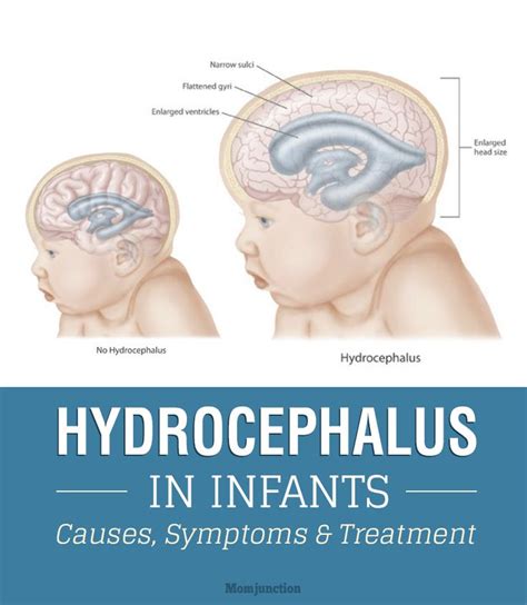 Hydrocephalus In Infants Causes Symptoms And Treatment Neonatal