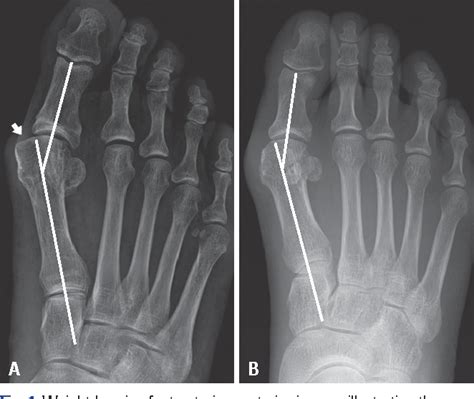 Figure 1 From Point Connecting Measurements Of The Hallux Valgus