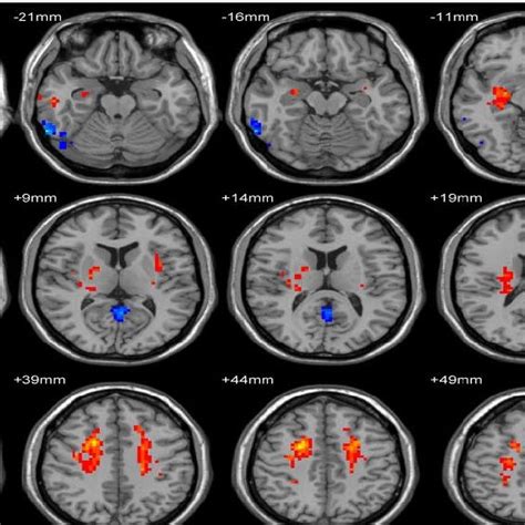 Fmri Scans Of Patients With Benign Epilepsy With Centrotemporal Spikes