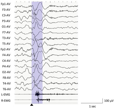 Frontiers Phase Lag Analyses On Ictal Scalp Electroencephalography