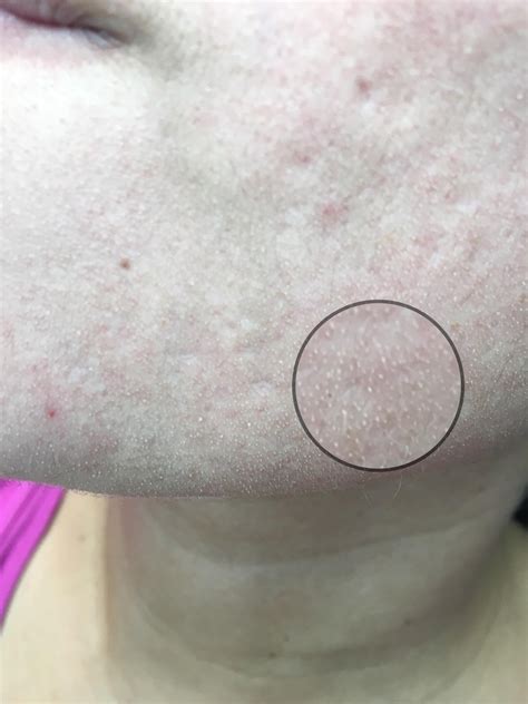 Skin Concerns Tiny Bumps After Acne Not Milia Not Whiteheads