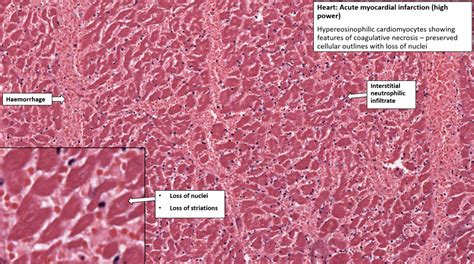 • chronic • mitral valve prolapse • rheumatic heart disease • ischemic heart disease • left ventricular dilatation of any cause • hypertrophic. Heart - Infarct - NUS Pathology