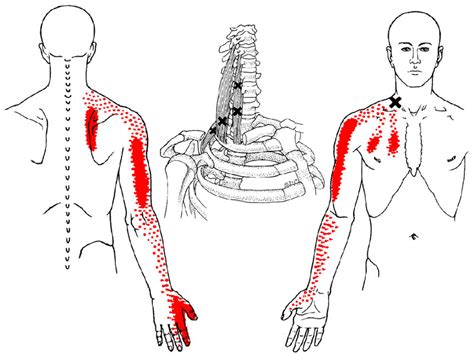 What Is A Trigger Point Indy Spine And Rehab