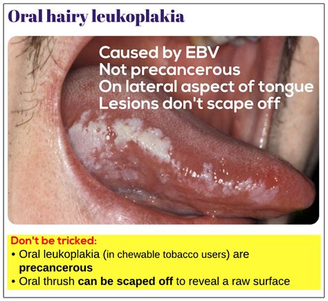 Oral Hairy Leukoplakia Medicine Keys For Mrcps