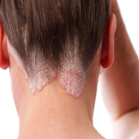 Scalp Psoriasis Symptoms Causes Treatment Diet In Australia