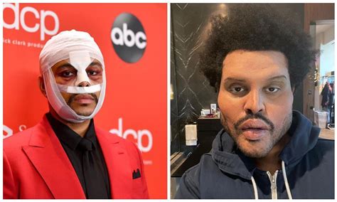 The Weeknd Reveals His Shocking New Plastic Surgery Look Fans Call