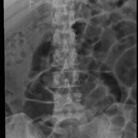 Ap View Of Lumbar Spine There Is Disc Narrowing At The L4 L5 Level