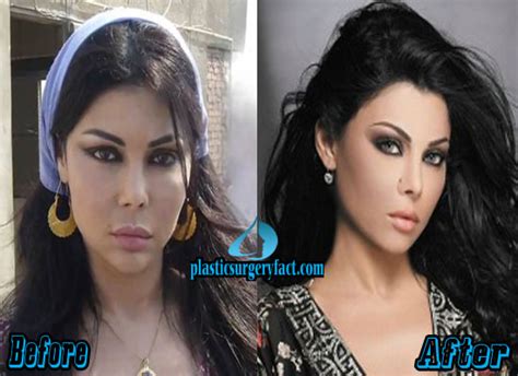 Haifa Wehbe Plastic Surgery Before And After Plastic Surgery Facts