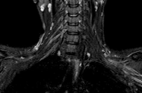 Brachial Plexitis Mri Sumers Radiology Blog