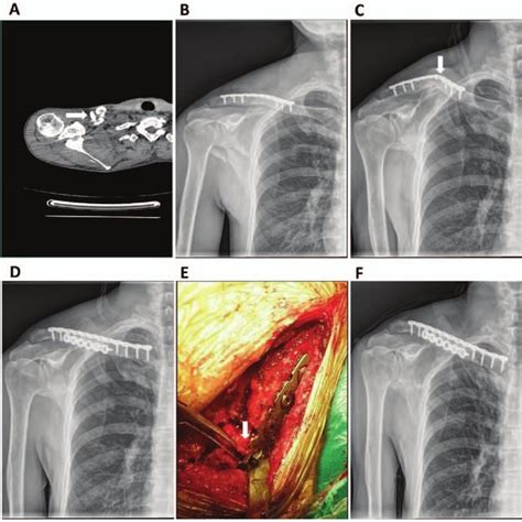 A Case With Plate Breakage And Clavicle Nonunion After Open Surgery Was