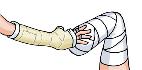 Injury Clipart Plaster Cast Injury Plaster Cast Transparent Free For