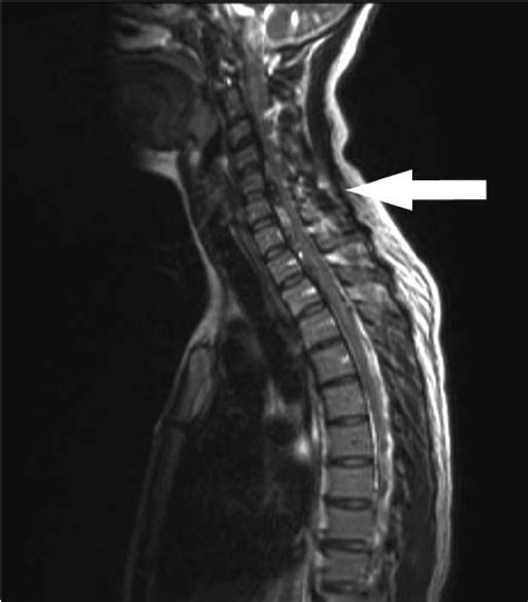 Sagittal T2 Weighted Mri Of The Cervical And Thoracic Spine Taken 5