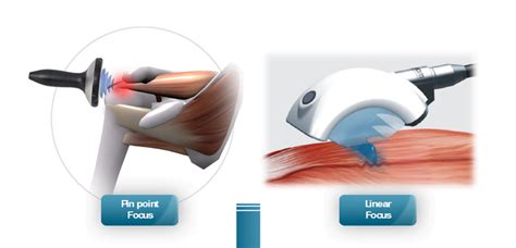 Ultrasound Guided Shockwave The Performance Physio