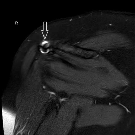 Pdspaircor6 Mrt Einer Rechten Schulter In Frontaler Ebene Doccheck