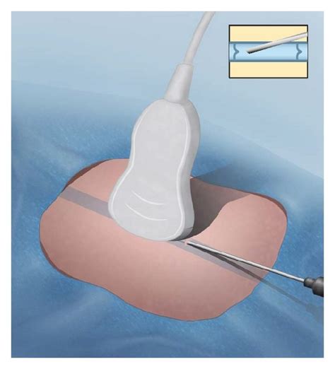 Illustration Of Ultrasound Guided Venous Access A Illustration