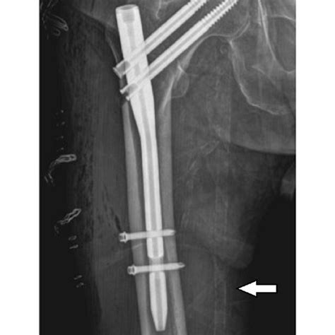 Pdf Does Presence Of Femoral Arterial Calcification Have An Effect On
