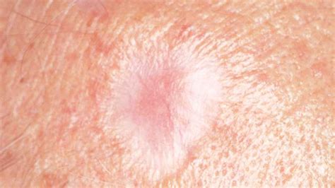 Skin Cancer What You Need To Know