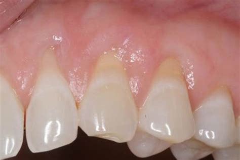 Gum Recession Detail Dental