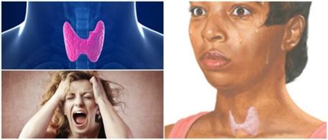 Síntomas De Hipertiroidismo ¿qué Es La Tiroides Y Posibles