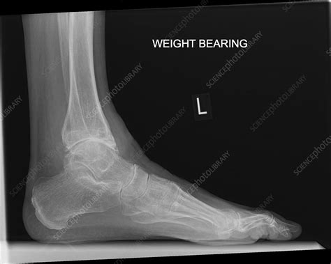 Osteoarthritis Of The Ankle X Ray Stock Image C0426410 Science