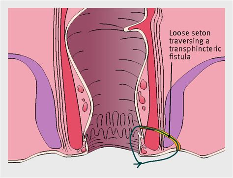 Management Of Anal Fistula The Bmj