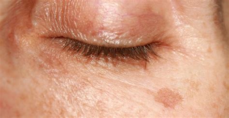 Treating Senior Skin Conditions Associated With Aging Skin Feisty