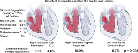 Effect Of Ventricular Pacing Lead Position On Tricuspid Regurgitation
