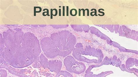 What Are Papillomas Pathology Mini Tutorial YouTube